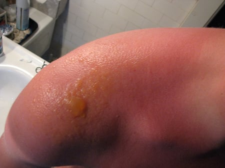 Sunburn_blisters